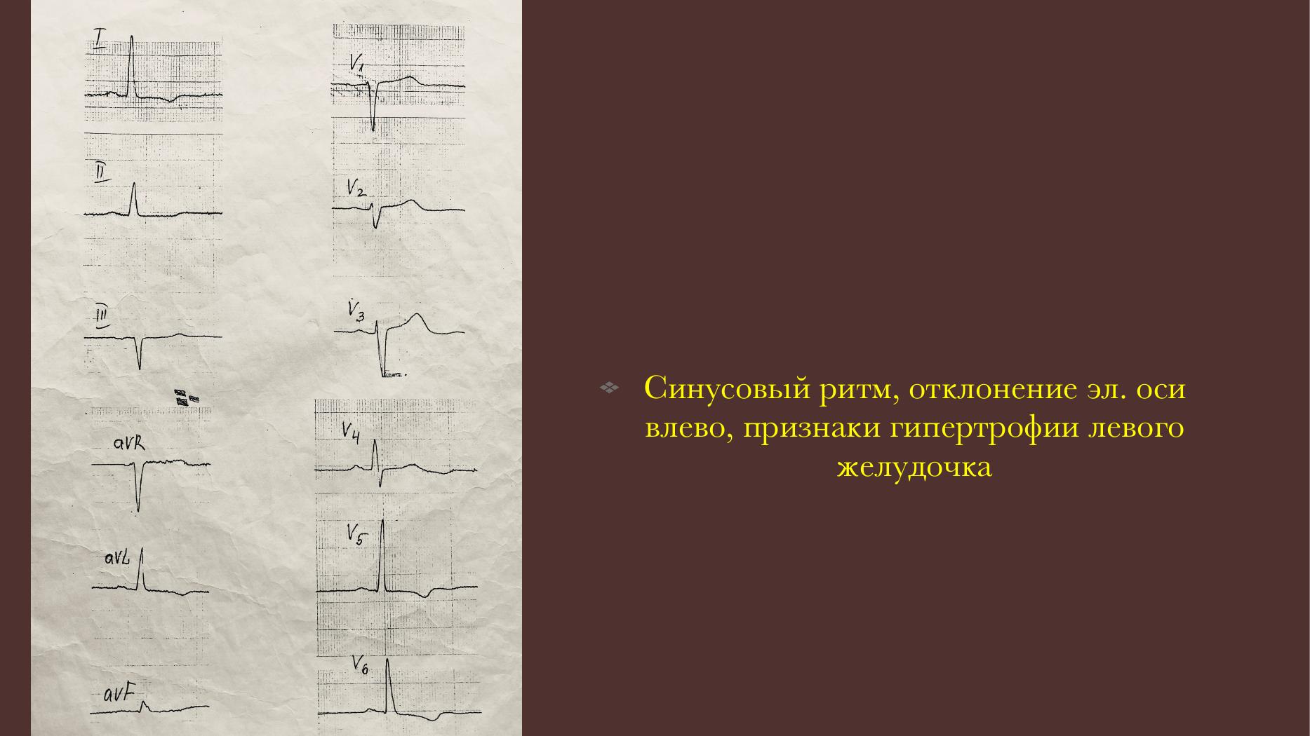 Гипертрофия левого желудочка