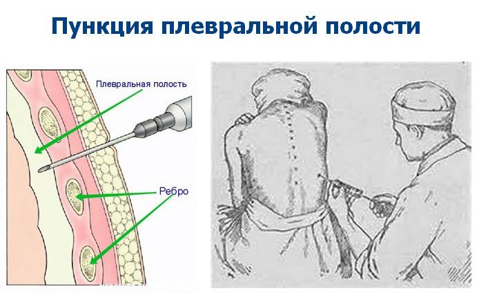 Пункция плевральной полости