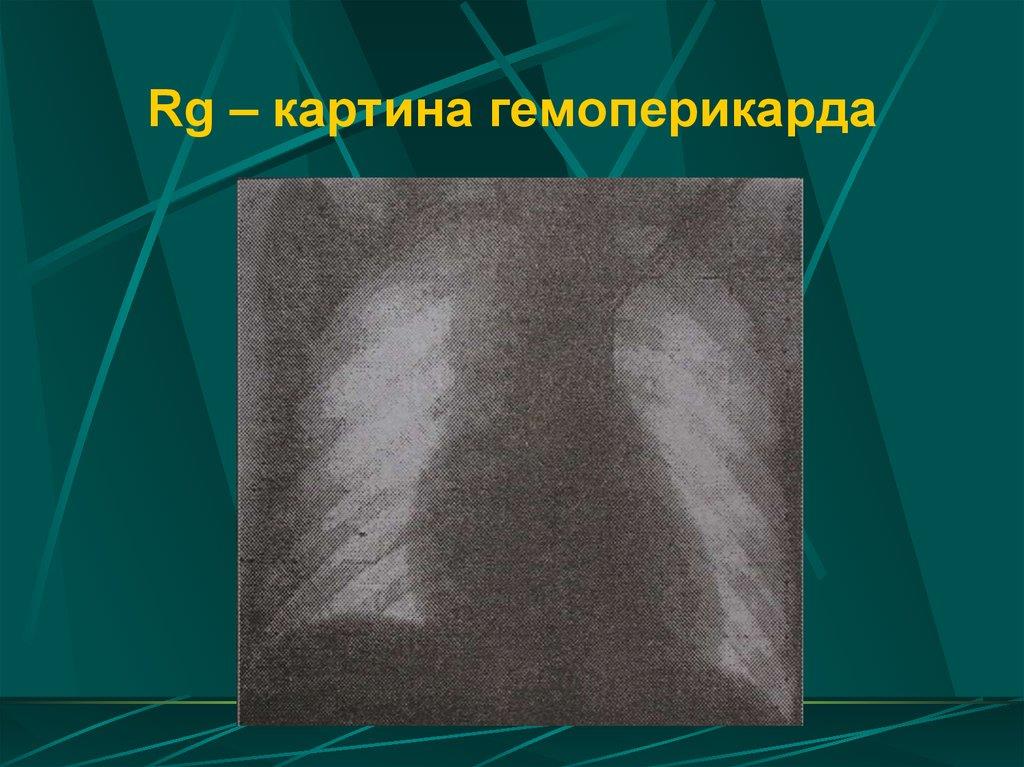Rg-картина гемоперикарда