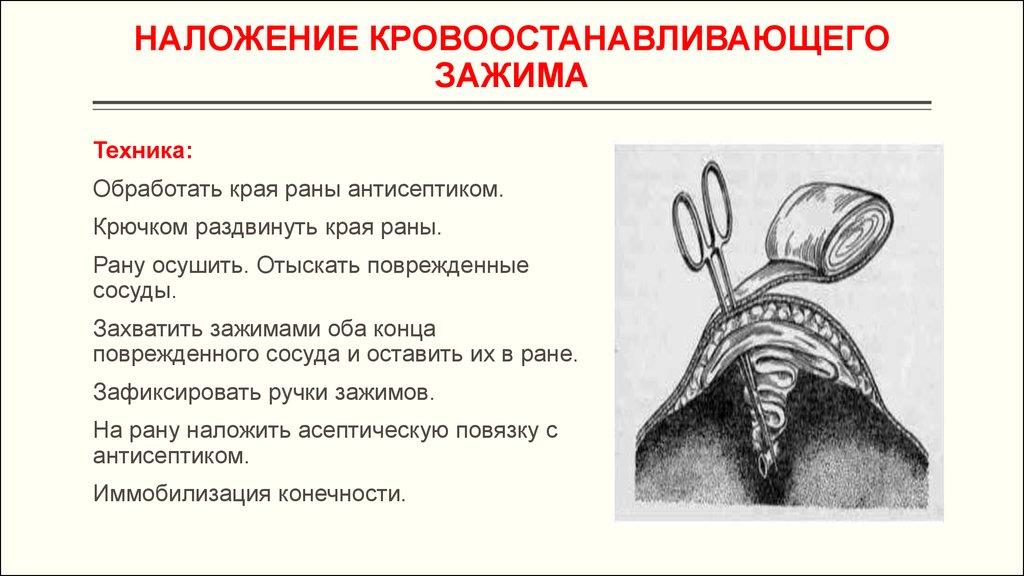 Наложение кровоостанавливающего зажима