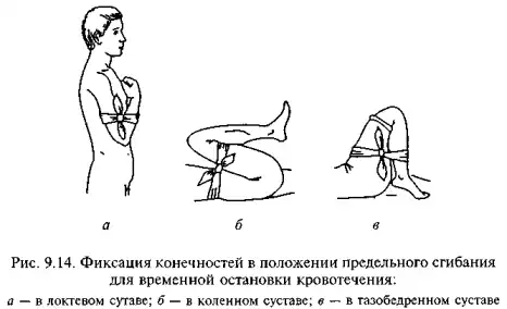 Фиксация конечности в положении предельного сгибания для временной остановки кровотечения