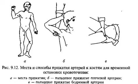 Места пальцевого прижатия артерий к костям для временной остановки кровотечения