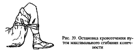Остановка кровотечения максимальным сгибанием конечности