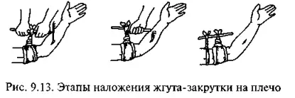 Этапы наложения жгута-закрутки на плечо