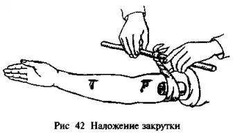 Наложение закрутки (импровизированный жгут)
